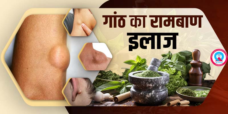 गांठ का रामबाण इलाज